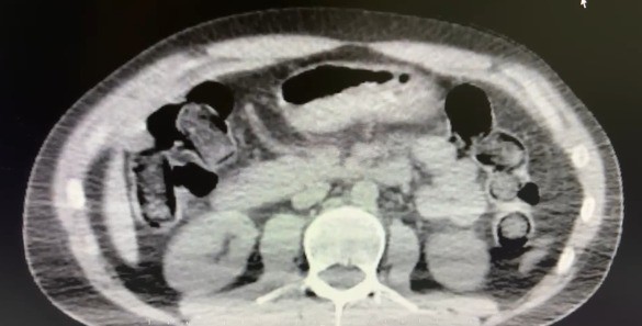 101 Kapsül Halindeki 722 Gram Uyuşturucuyu Midelerinde Saklayan 2 Sokak Satıcısı Tutuklandı